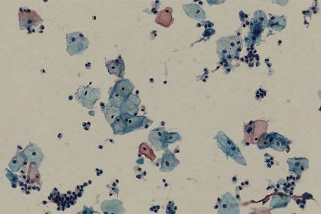Microscopisch beeld van een cytologisch dunnelaagpreparaat met Papanicolaoukleuring