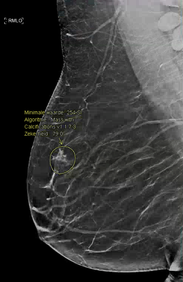 hetzelfde mammografische beeld, bewerkt met AI