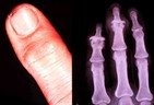 afbeelding van vingers met artrose