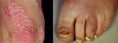 AFbeelding van voeten met psoriasis artritis