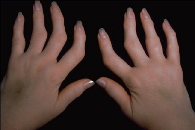 Afbeelding van handen met reumatoïde artritis