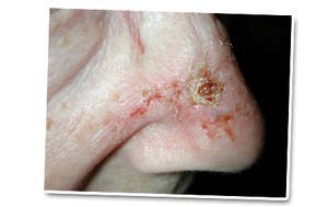 afbeelding van basaalcelcarcinoom op de neus