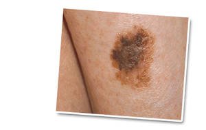 afbeelding van een oppervlakkig spreidend melanoom