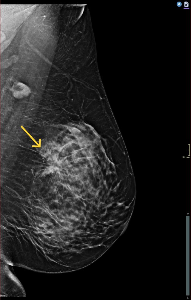 klassieke mammografie